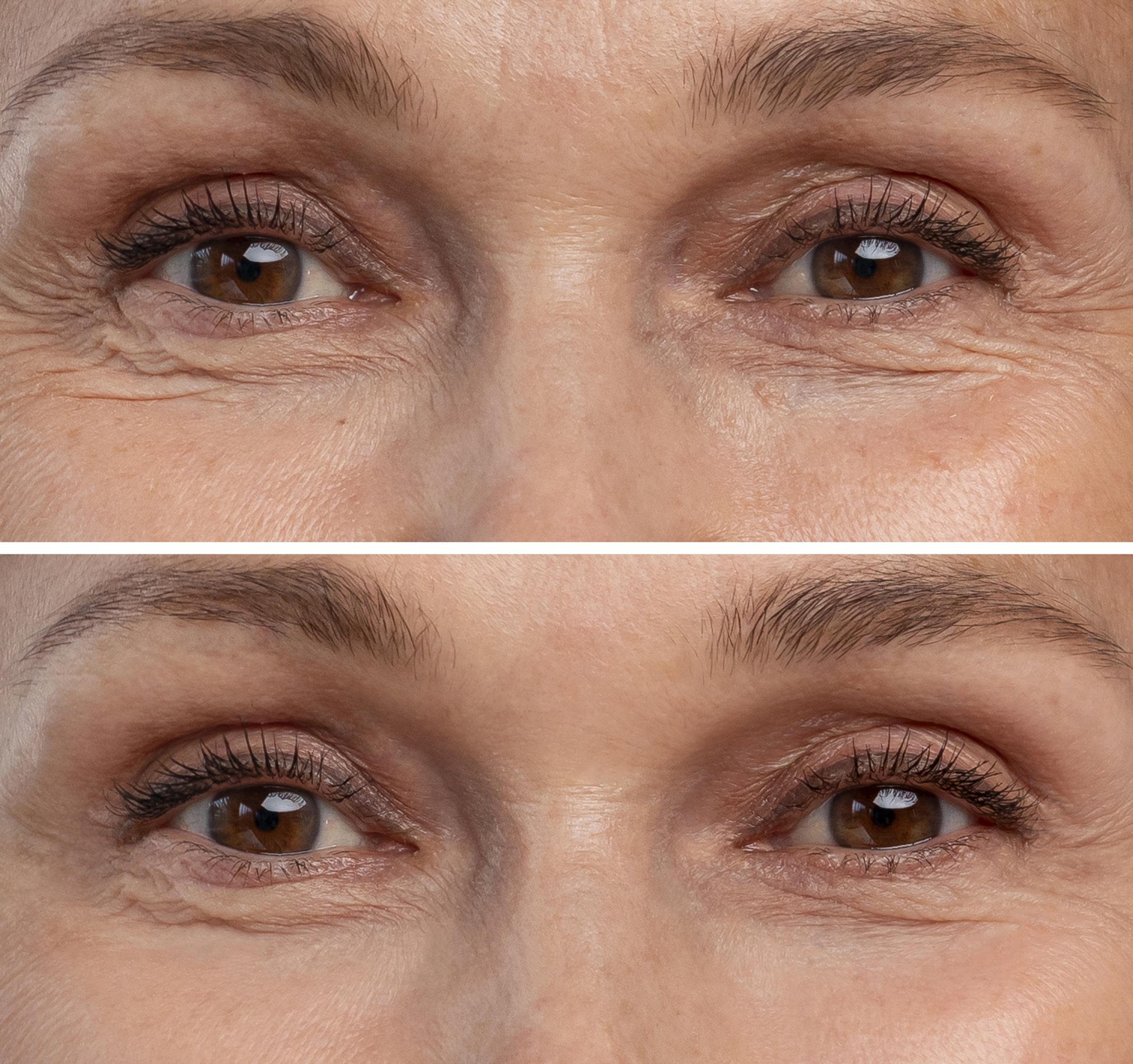 Woman eye filler before and after comparison