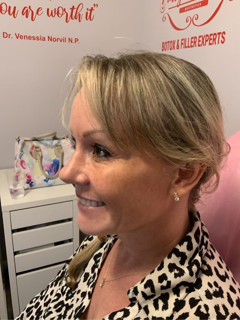 Older Pretty Perfect You Customer sideshot crow's feet eye filler