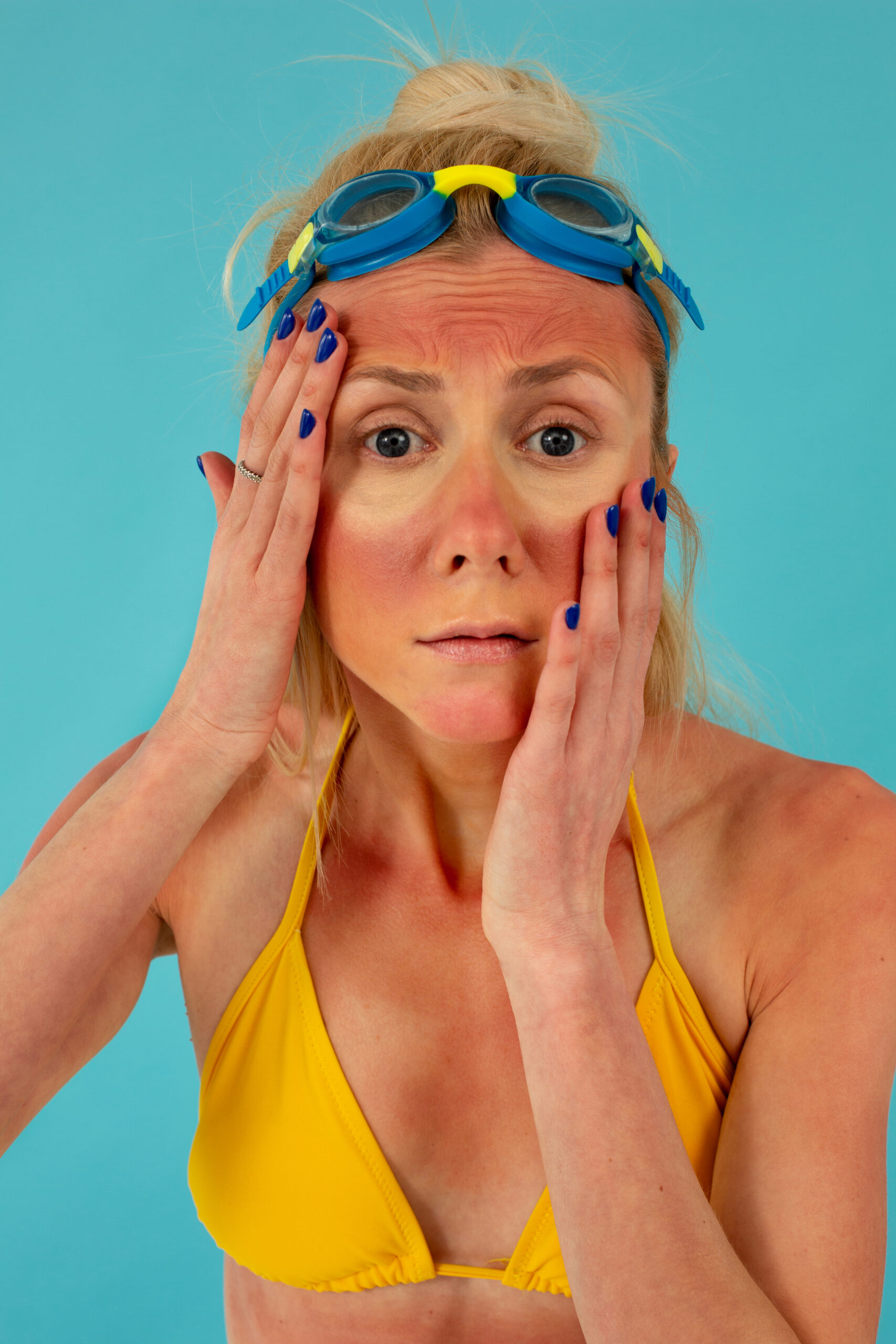 Woman with sunburn in need of skincare routine